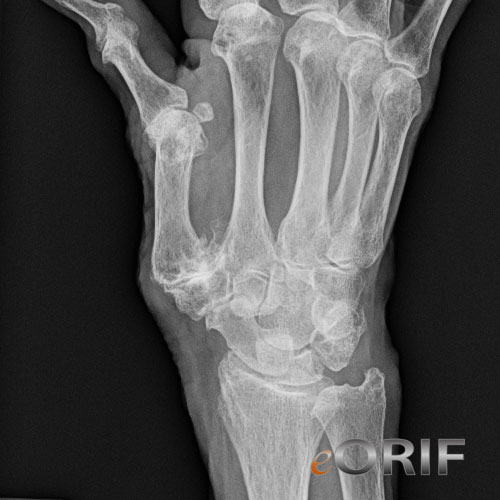 thumb basilar joint arthritis xray thumb basilar joint arthritis xray