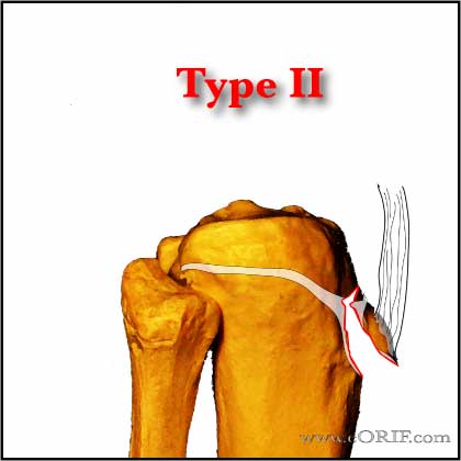 Tibial Tubercle Avlusion Fracture Type II Tibial Tubercle Avlusion Fracture Type II
