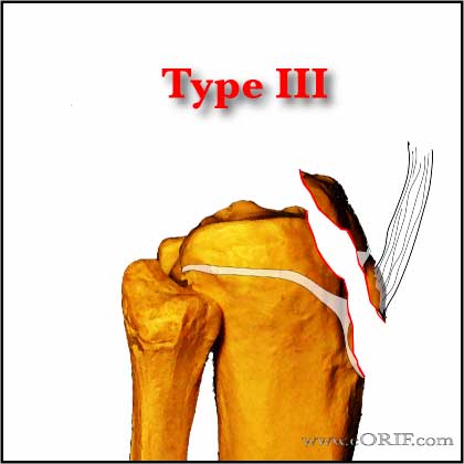 Tibial Tubercle Avlusion Fracture Type III Tibial Tubercle Avlusion Fracture Type III