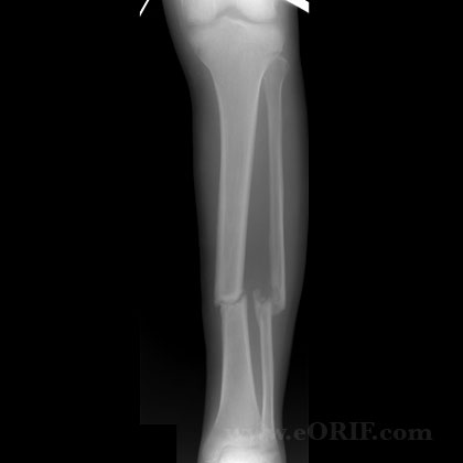 Tibial shaft fracture nonunion A/P xray Tibial shaft fracture nonunion A/P xray