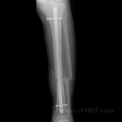 Tibial shaft fracture nonunion IM nail Tibial shaft fracture nonunion IM nail xray