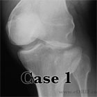 Tibial plateau fracture Tibial plateau fracture xray