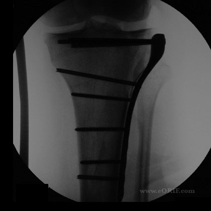 tibial plateau fracture xray tibial plateau fracture xray