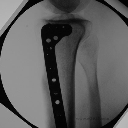 tibial plateau fracture xray
