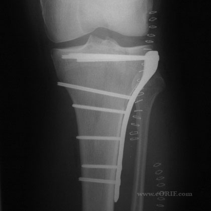 tibial plateau fracture xray