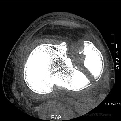 tibial plateau fracture CT