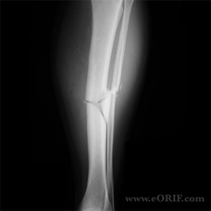Tibial shaft fracture Tibial shaft fracture xray
