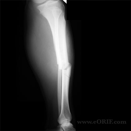 Tibial shaft fracture xray Tibial shaft fracture lateral view xray
