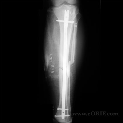 Tibial IM nail xray Tibial shaft IM nail xray