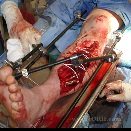 Tibial shaft external fixation image Tibial shaft external fixation image