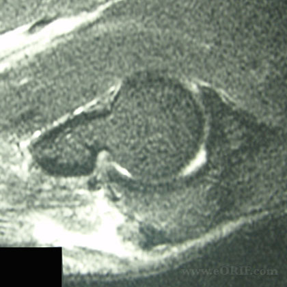 tricpes tendon rupture mri triceps tendon rupture mri