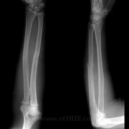 ulnar shaft fracture xray ulnar shaft fracture xray
