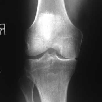 medial compartment arthritis xray medial compartment arthritis xray