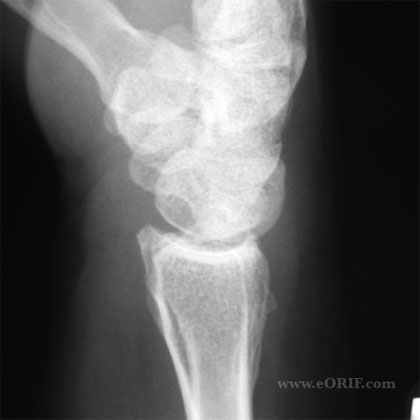 wrist arthritis lateral view xray
