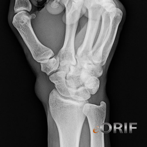 wrist scaphoid view xray wrist scaphoid view xray